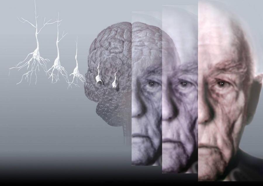 Alzheimer  Falha em estudo coloca em xeque a hipótese da placa